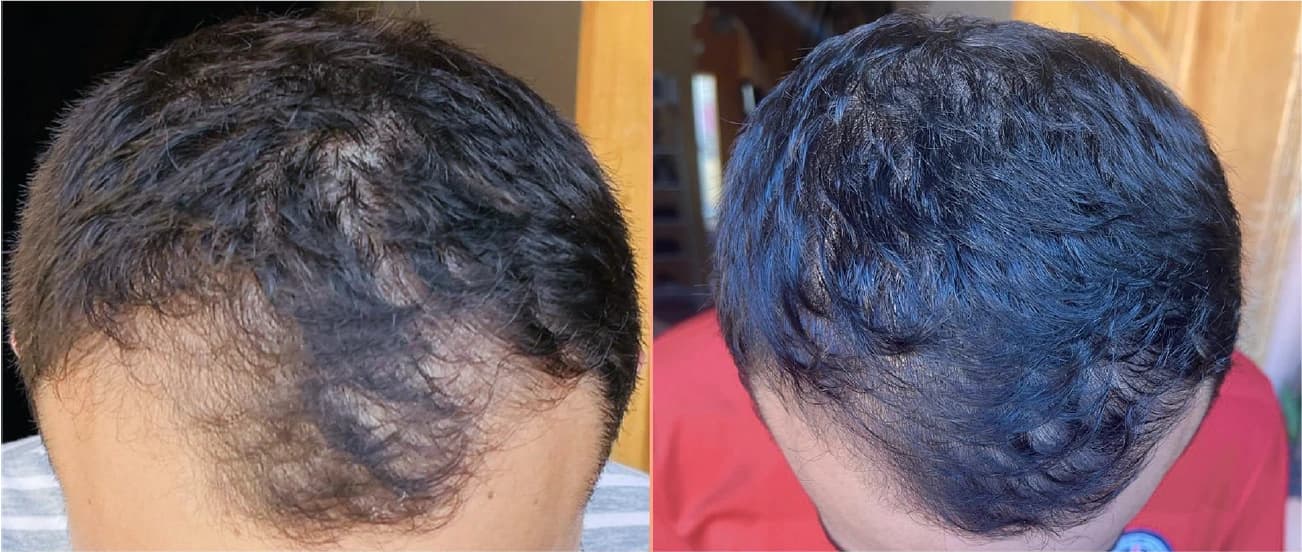 Før- og efterbillede af hårtæthed ved den forreste hårgrænse