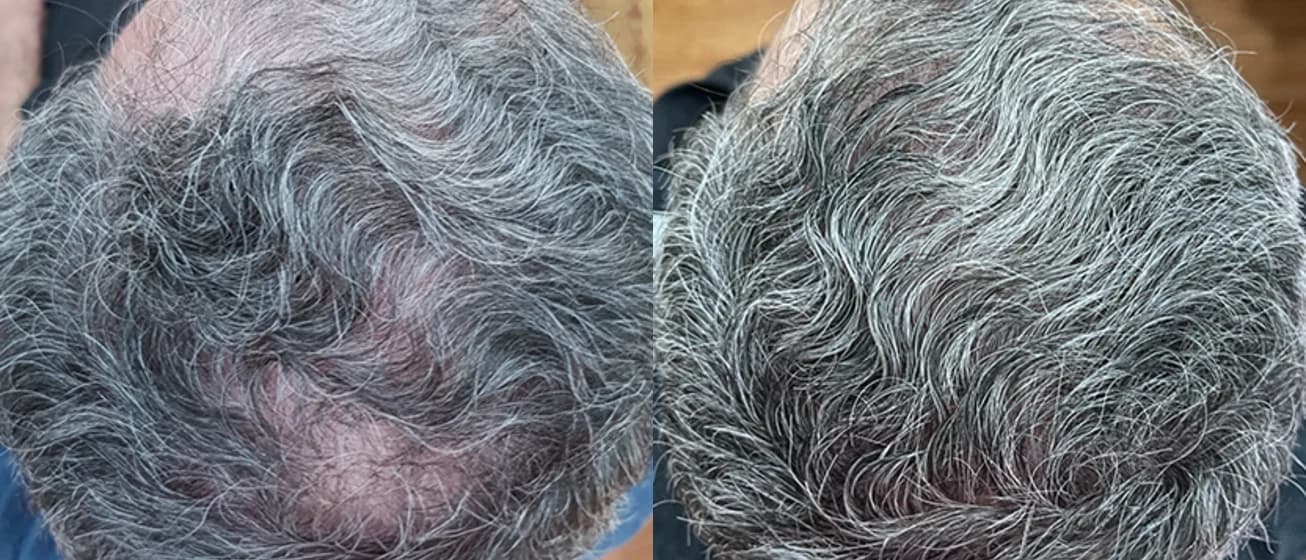 Før- og efterbillede af hovedbunden efter ActivaHair-behandling
