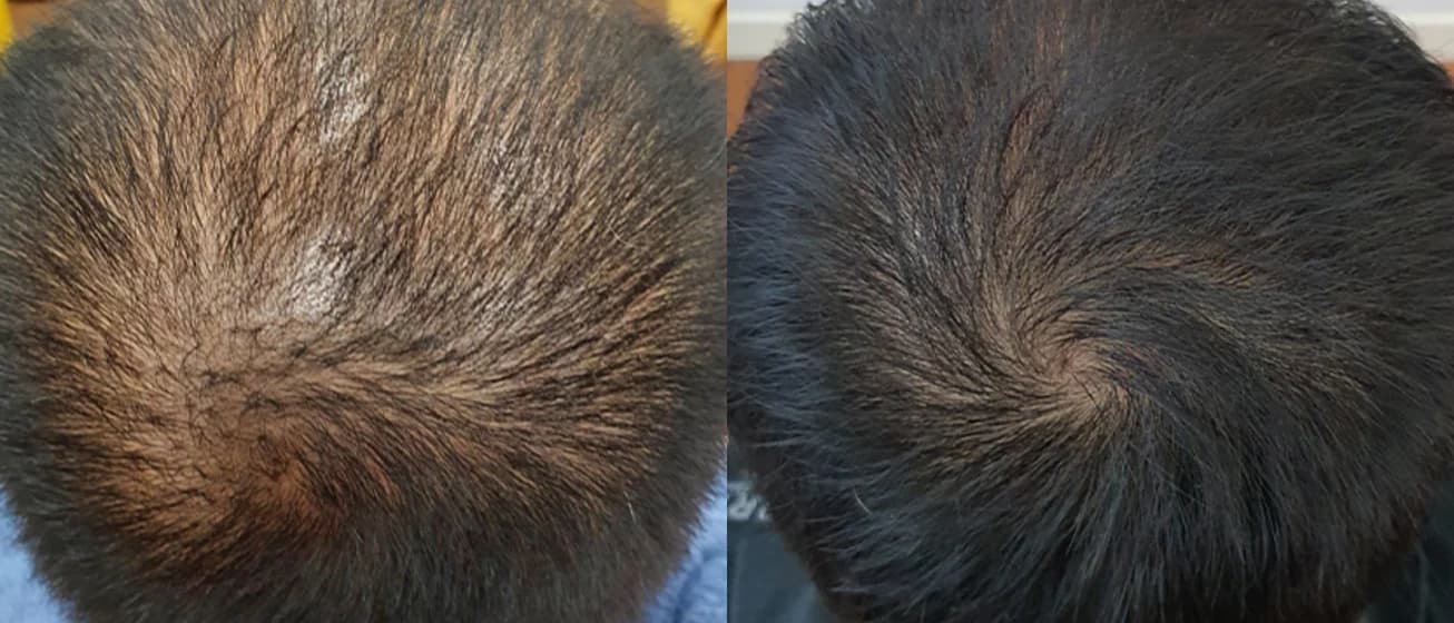 Før- og efterbillede af hovedbunden efter ActivaHair-behandling