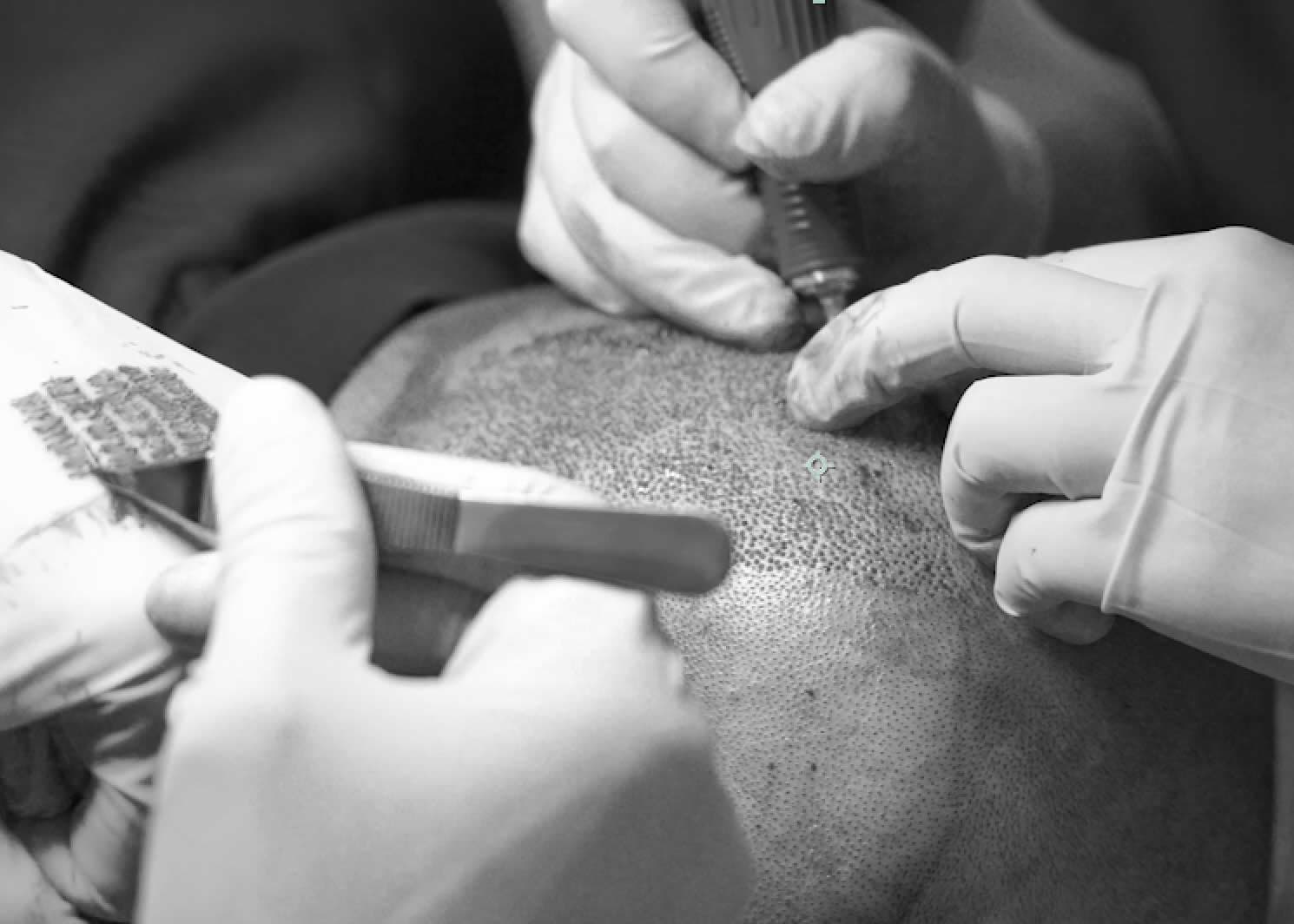 Hårtransplantation med fokus på donor- og modtagerområde